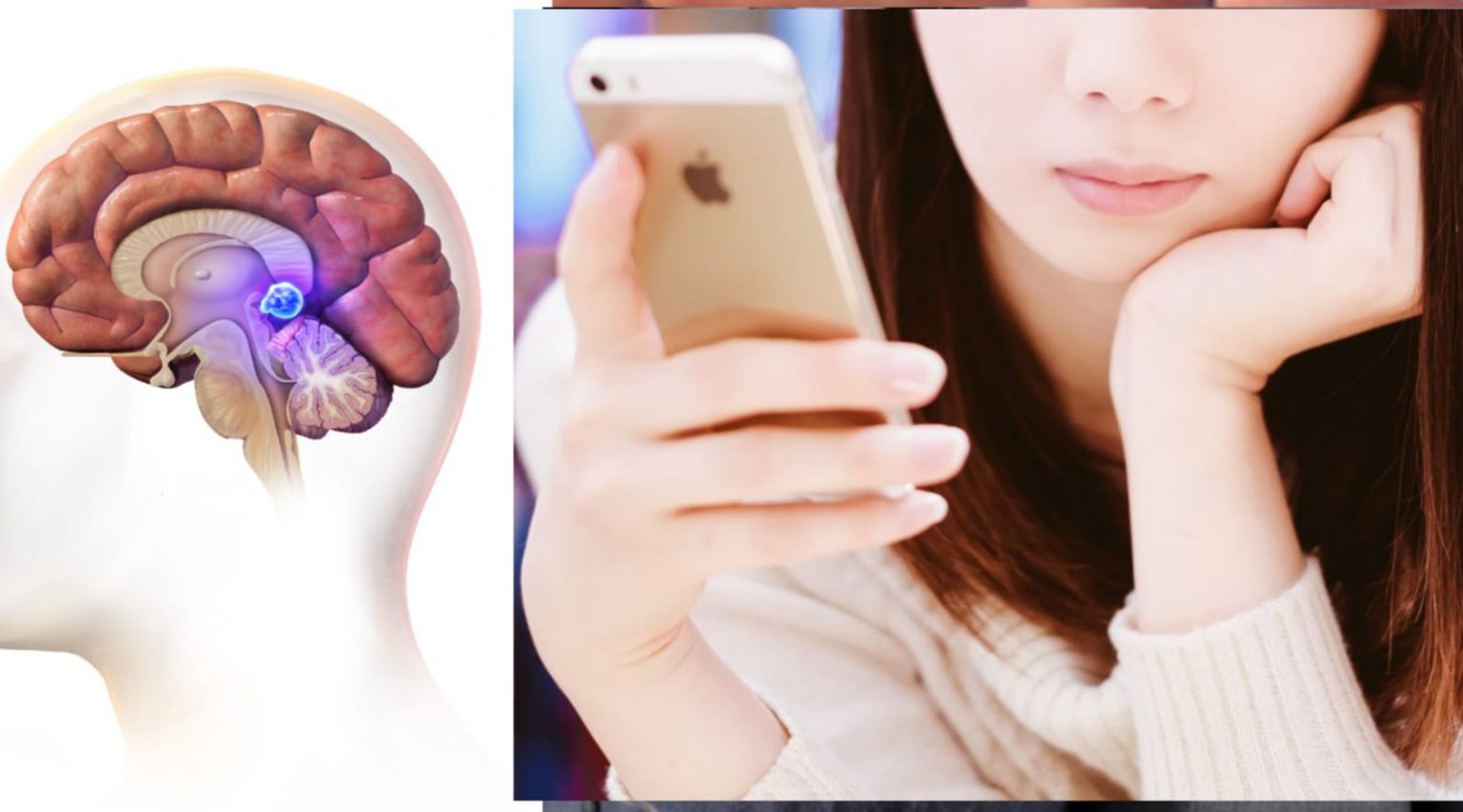 brain tumor due to smartphone