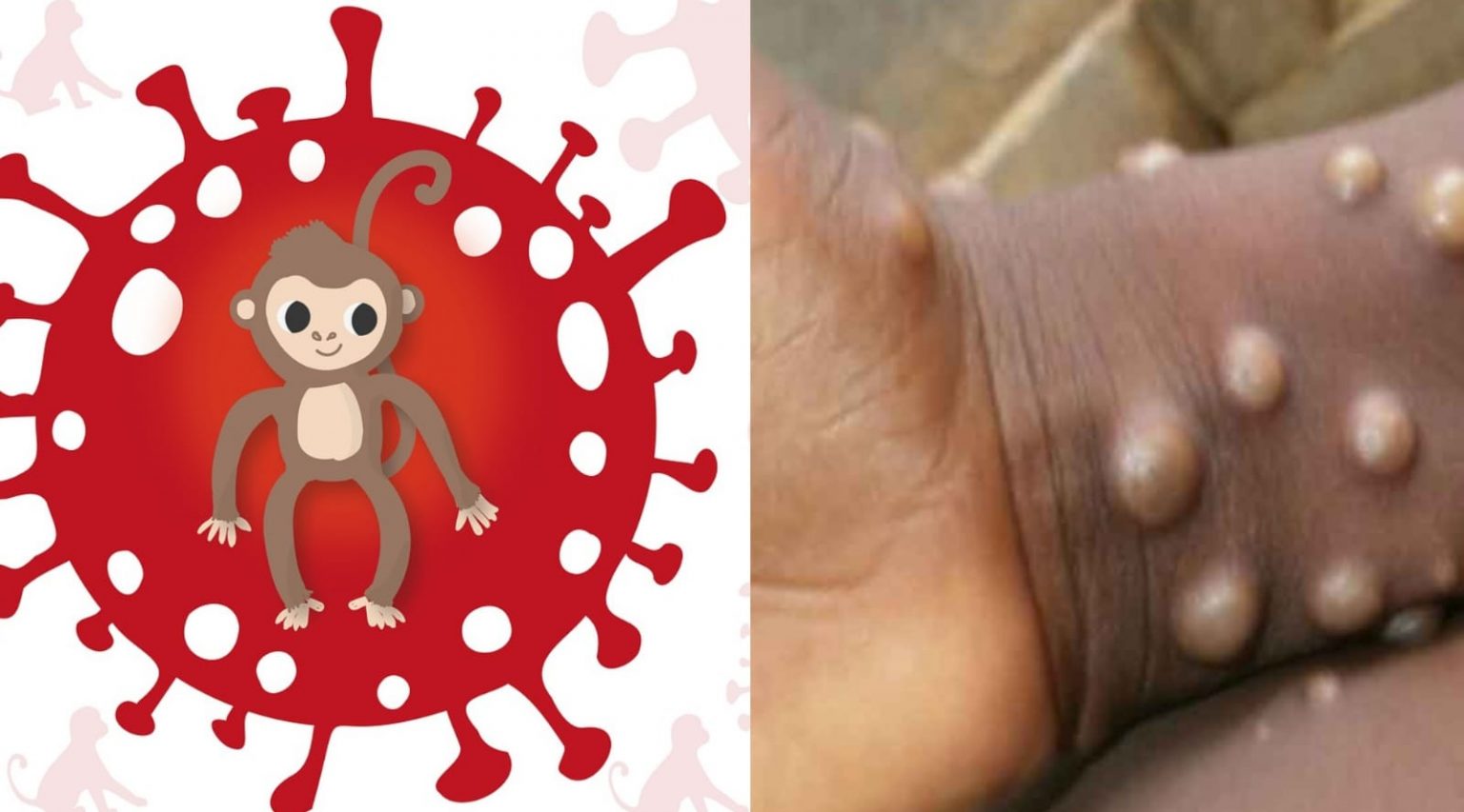 Monkeypox