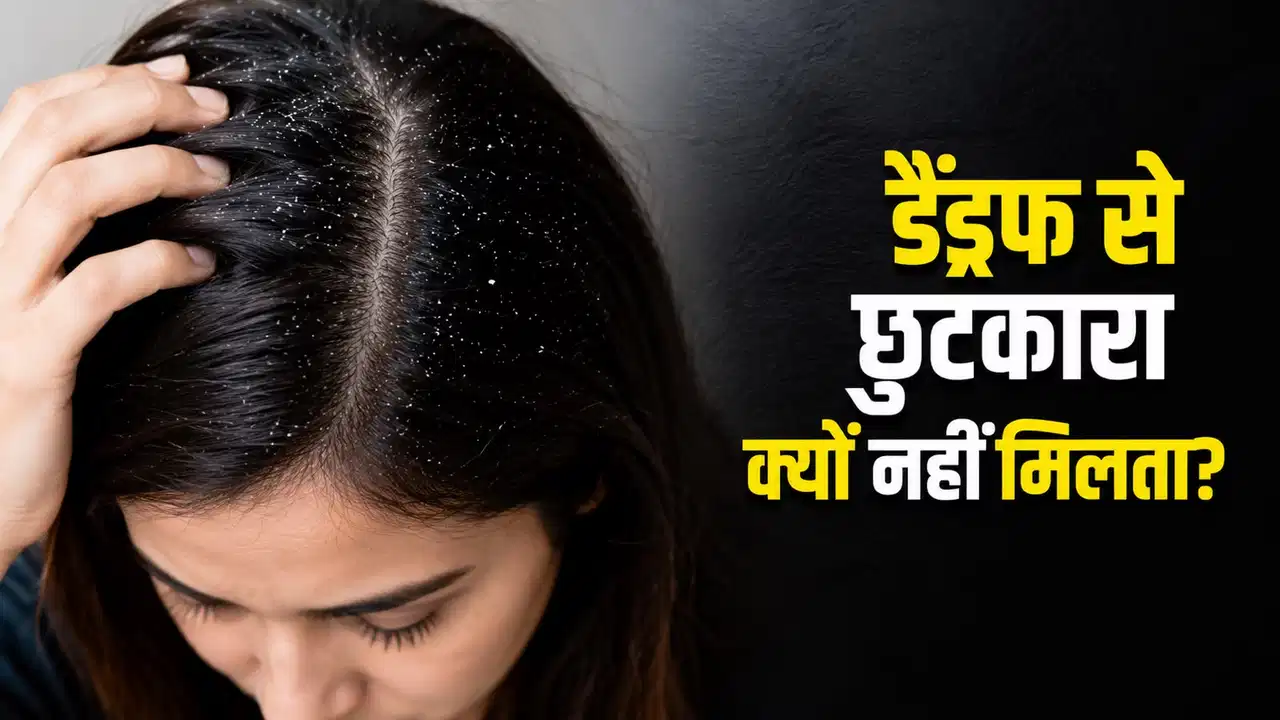 Dandruff Treatment: Is your dandruff constantly returning? Find out which mistakes are aggravating your scalp problem.